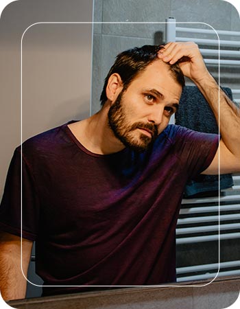 Receding Hairline in Folsom, CA