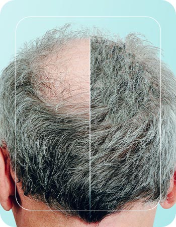 Thinning Crown in Folsom, CA