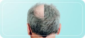 Thinning Crown Specialist in Folsom, CA