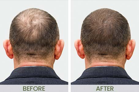 Before & After Photos at NorCal Hair Institute in Folsom, CA