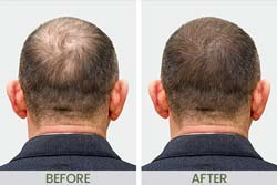 Before & After Photos at NorCal Hair Institute in Folsom, CA