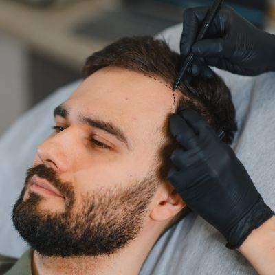 FUE Hair Surgery Near Me in Folsom, CA