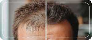Male Hair Transplant Specialist in Folsom, CA