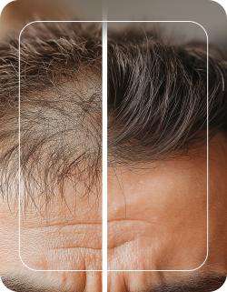 Male Hair Transplant Specialist in Folsom, CA